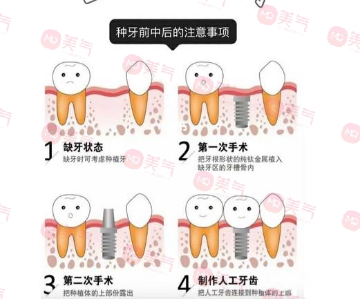 上海種植牙價(jià)格表大全更新！低至5900？?jī)?nèi)附種植牙原理、注意事項(xiàng)
