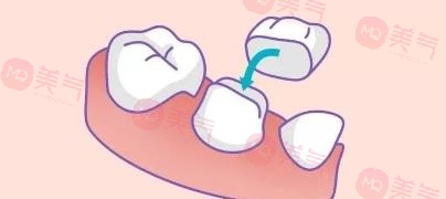 補一顆烤瓷牙多少錢？較多的價格因素影響你了解幾個？