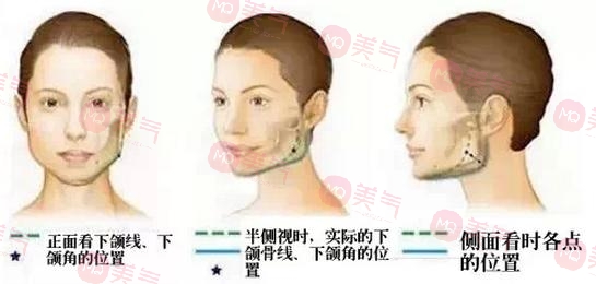北京八大處頜面外科哪個大夫好？張智勇醫(yī)生-下頜角案例圖反饋