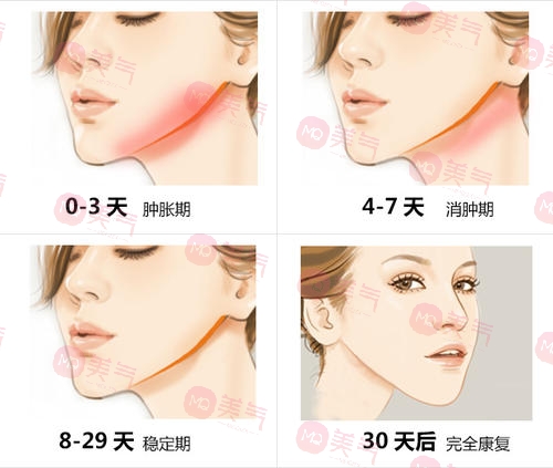 北京八大處頜面外科哪個大夫好？張智勇醫(yī)生-下頜角案例圖反饋