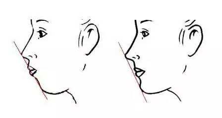 凸嘴改善介紹,效果、價(jià)格和優(yōu)缺點(diǎn)是什么？