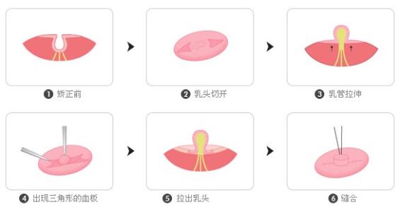 乳頭凹陷矯正多少錢(qián)？效果怎么樣？簡(jiǎn)介和優(yōu)缺點(diǎn)盤(pán)點(diǎn)