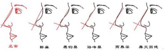 鷹鉤鼻矯正要多少錢？項(xiàng)目介紹和案例展示