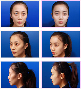 自體血清美膚真的有嗎?項(xiàng)目簡(jiǎn)介_(kāi)真實(shí)案例_優(yōu)缺點(diǎn)介紹