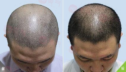 重慶毛發(fā)種植哪里有好的專業(yè)機構(gòu)嗎？