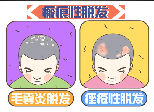 廣州倍生植發(fā)醫(yī)院技術(shù)如何？選對醫(yī)院不再為禿頭煩惱！
