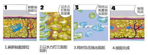 水動(dòng)力吸脂減肥2.jpg