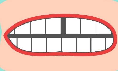 牙縫大了怎么補(bǔ)救？常見的修復(fù)方式就是貼面修復(fù)，正畸矯正，牙冠修復(fù)等