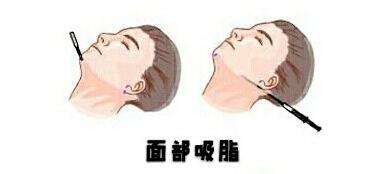 面部吸脂動(dòng)漫03.jpg