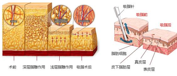 水動力吸脂減肥4.jpg