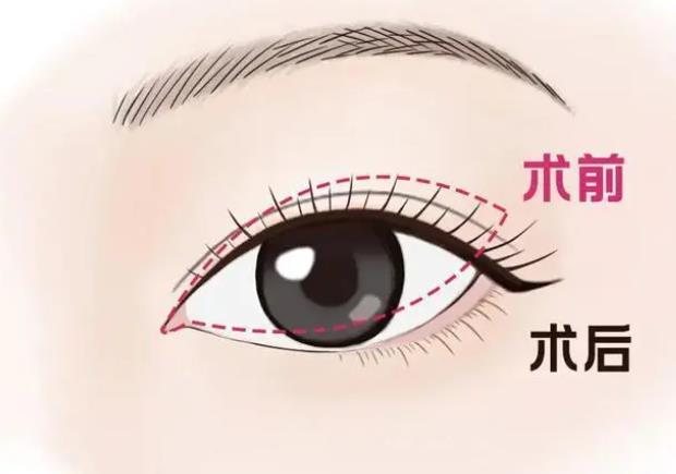 雙眼皮動漫001.jpg