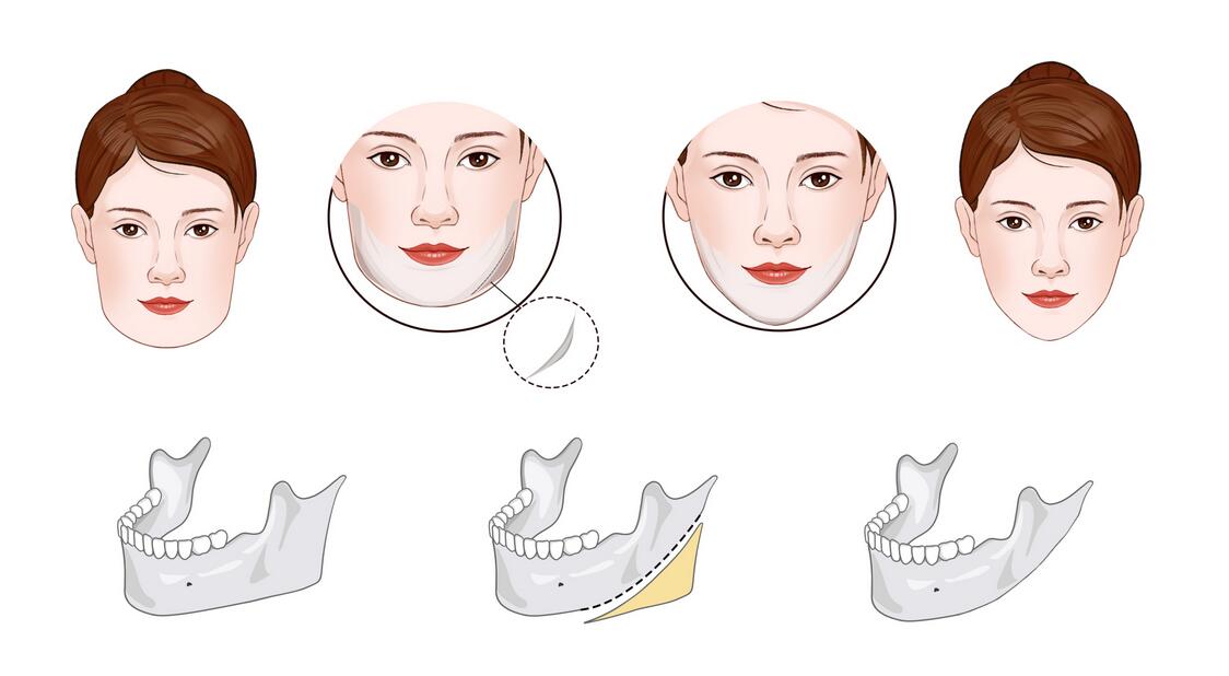 下頜角3.jpg 下頜角3.jpg