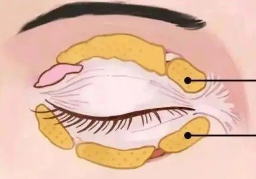 雙眼皮修復(fù)動漫h22.jpg