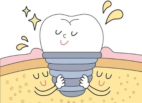 種三顆牙需要多少錢(qián)？需要3000元到1萬(wàn)元之間，根據(jù)材料的不同，價(jià)格也會(huì)有較大的差異