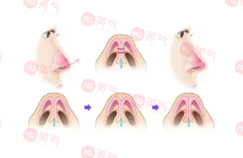 自體肋骨隆鼻的危害有哪些？手術(shù)風(fēng)險(xiǎn)、疼痛和腫脹…