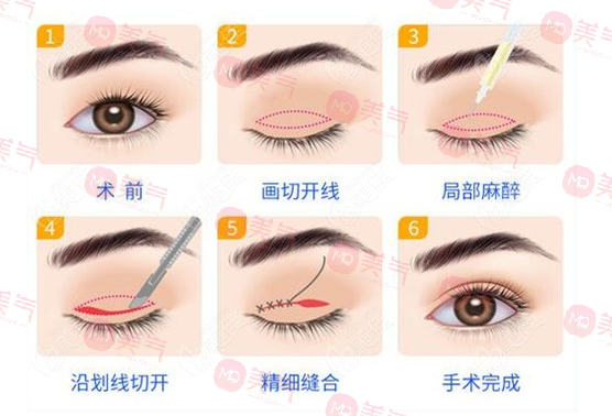 上海九院雙眼皮哪個醫(yī)生比較好？