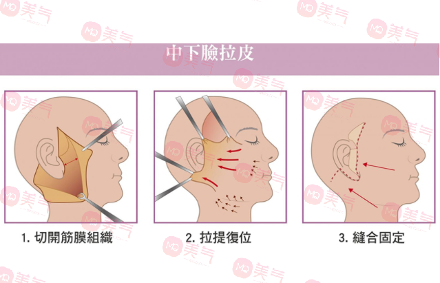 上海九院拉皮手術(shù)哪個醫(yī)生做的好？