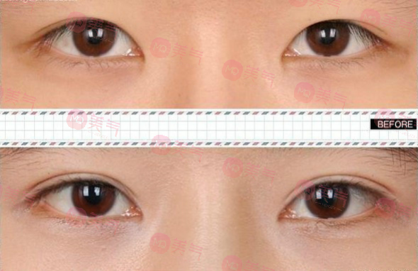 北京八大處整形雙眼皮多少錢？