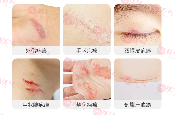 北京八大處整容醫(yī)院做疤痕修復多少錢？