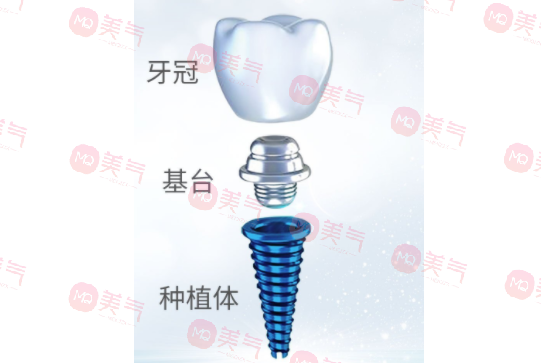 種植牙齒多少錢一顆2023？種植體品牌、醫(yī)生選擇都決定了定價！