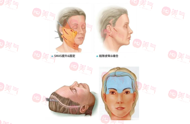 北京煤醫(yī)王馳拉皮手術(shù)多少錢？醫(yī)生技術(shù)介紹+價(jià)格表參考