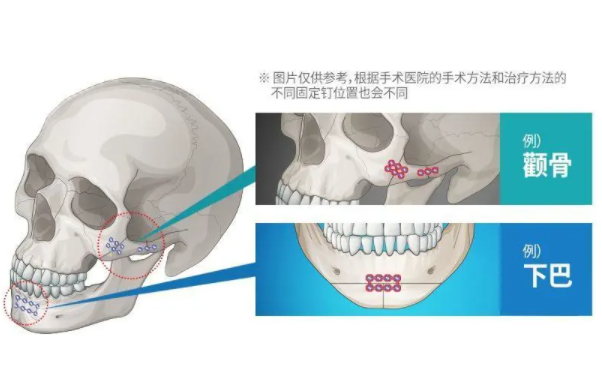 上海李志海和柴崗顴骨顴弓術(shù)手術(shù)費(fèi)用分別是多少？