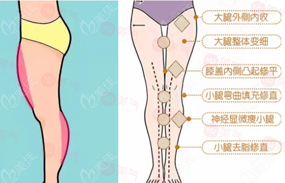 臀部吸脂手術(shù)優(yōu)點(diǎn)、作用、注意事項(xiàng)介紹