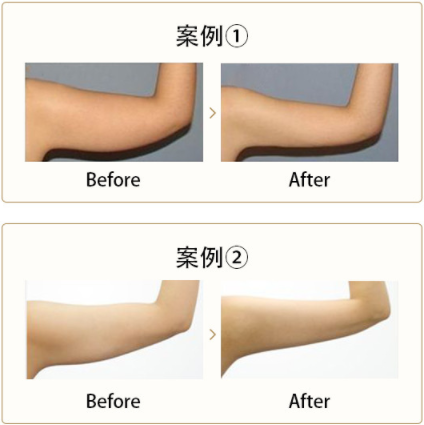 手臂吸脂手術